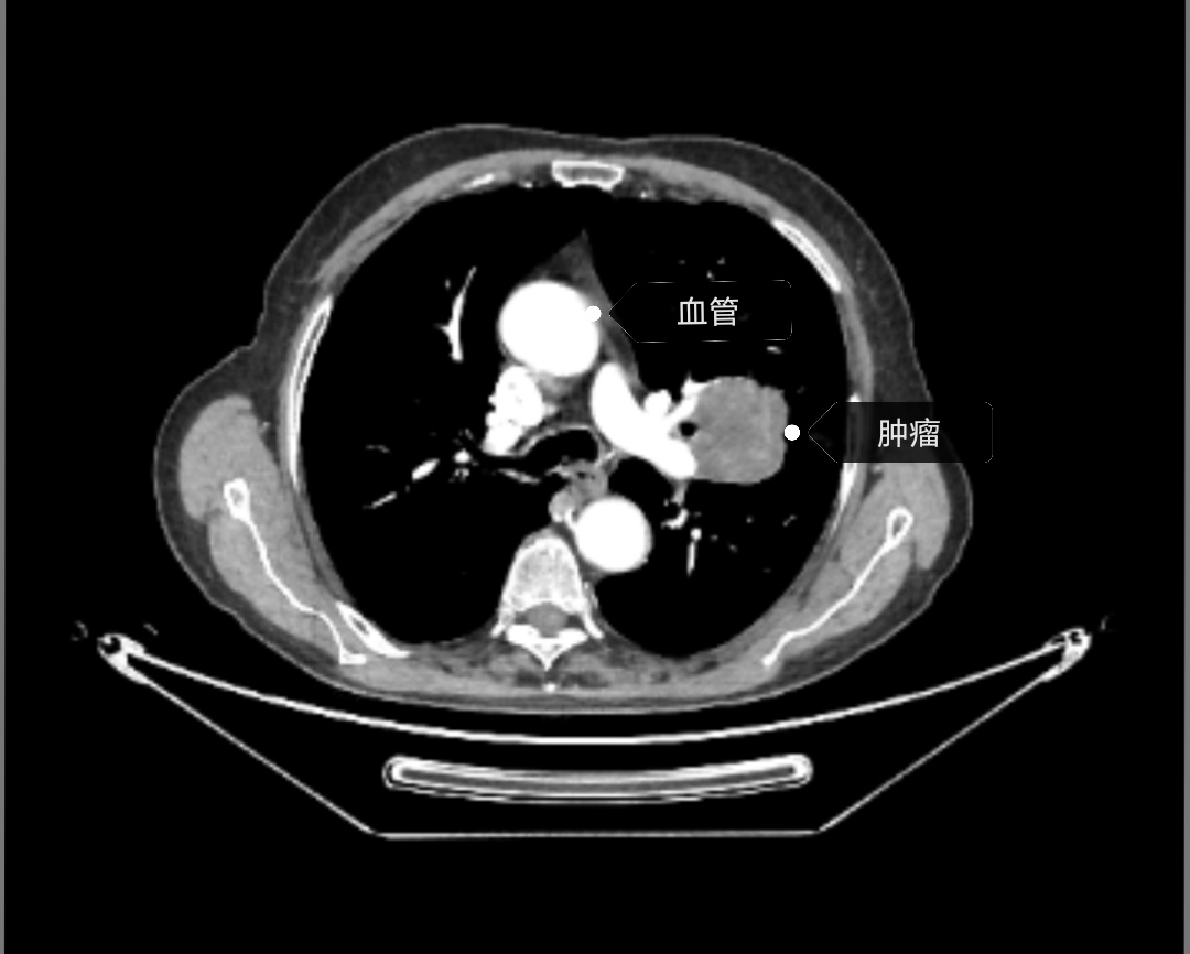 肺镜发现肿瘤,肺肿瘤放疗的副作用有哪些