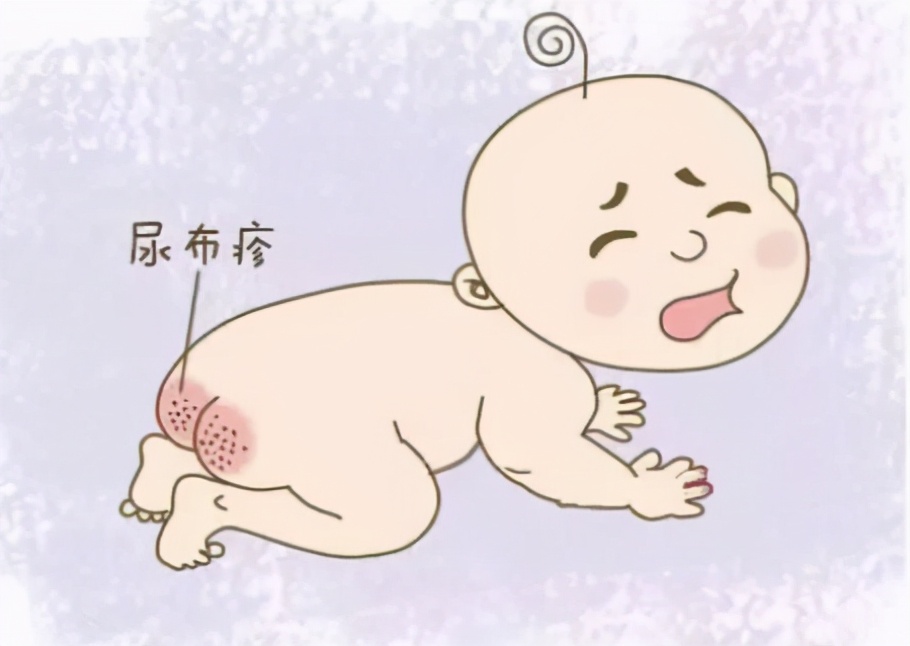 美力源育儿讲堂:宝宝总是会出现红屁股怎么办
