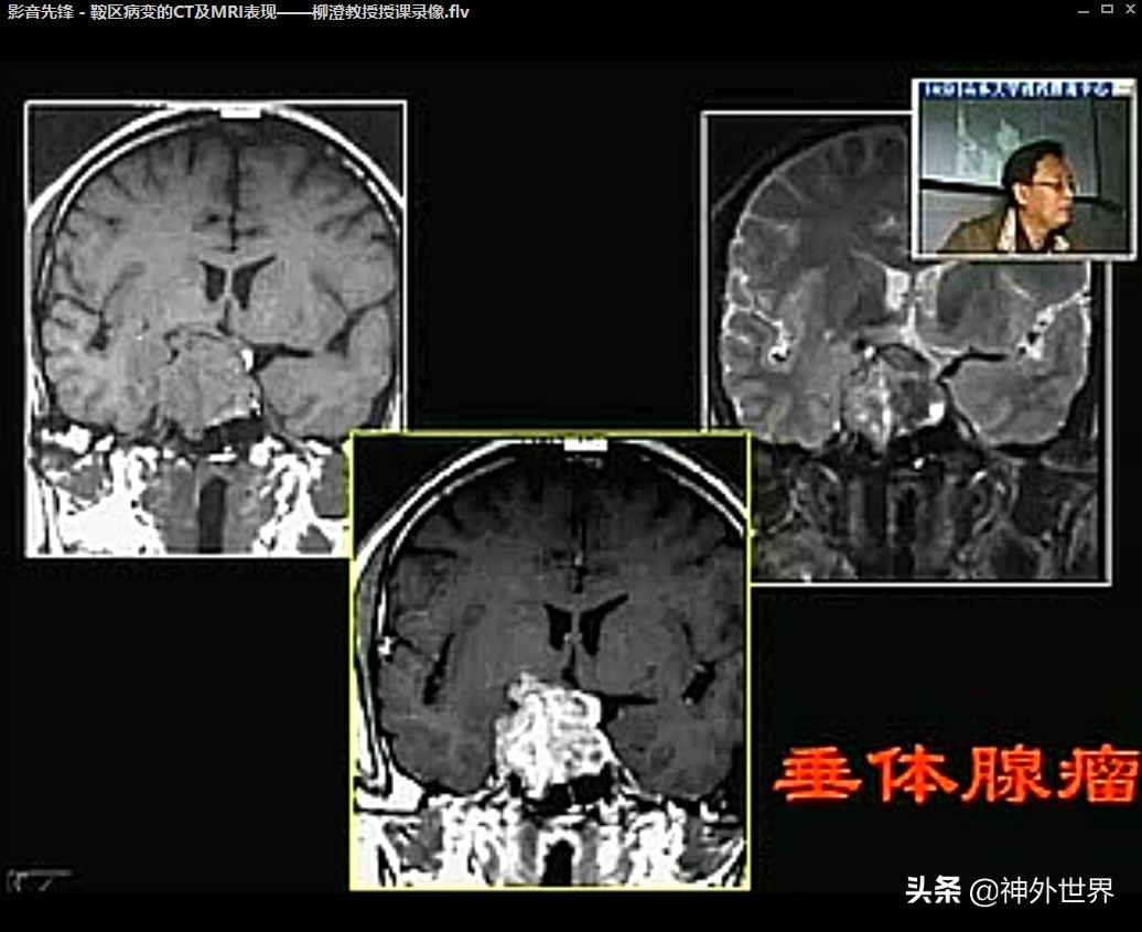 鞍区核磁解剖图,鞍区解剖与手术