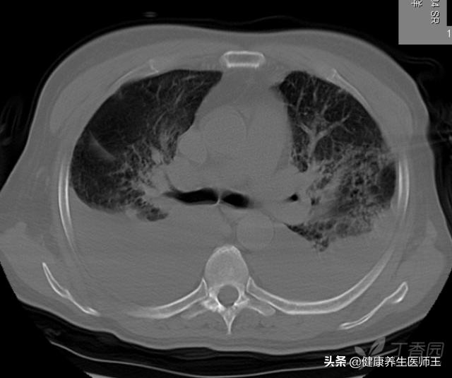 肺部感染的抗生素治疗病例,肺部感染常见的病原菌和抗生素