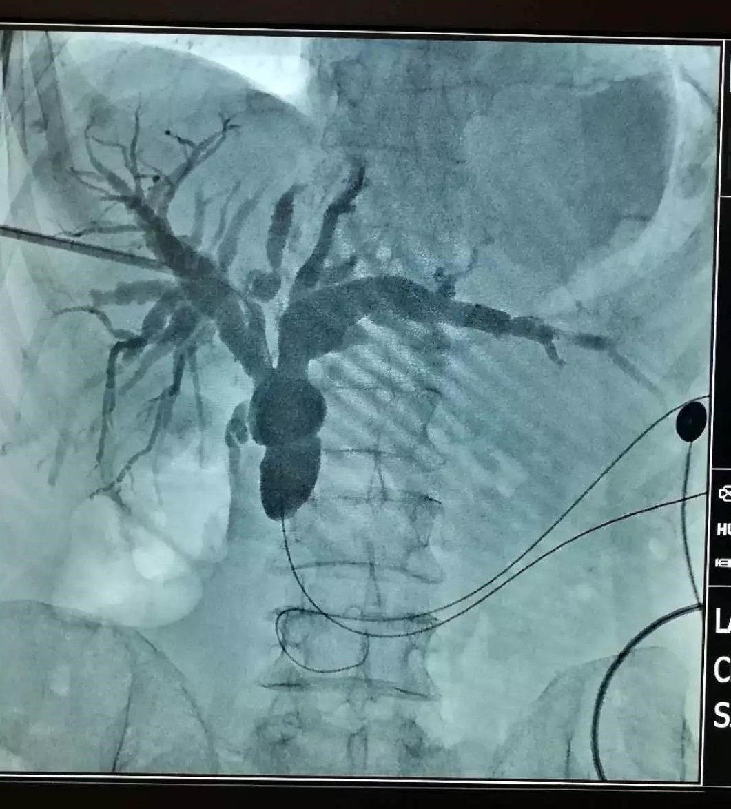 胆肠吻合术后吻合口狭窄梗阻咋办,胆肠吻合术后胆瘘怎么处理