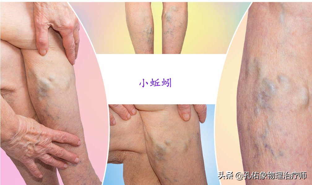 腿上细血管像蜘蛛样怎么回事,小腿上的血管像小蚯蚓一样