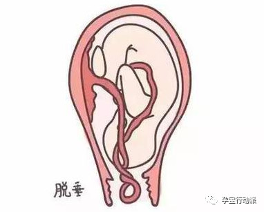 什么是脐带脱垂如何处理,臀位宝宝脐带脱垂有什么感觉