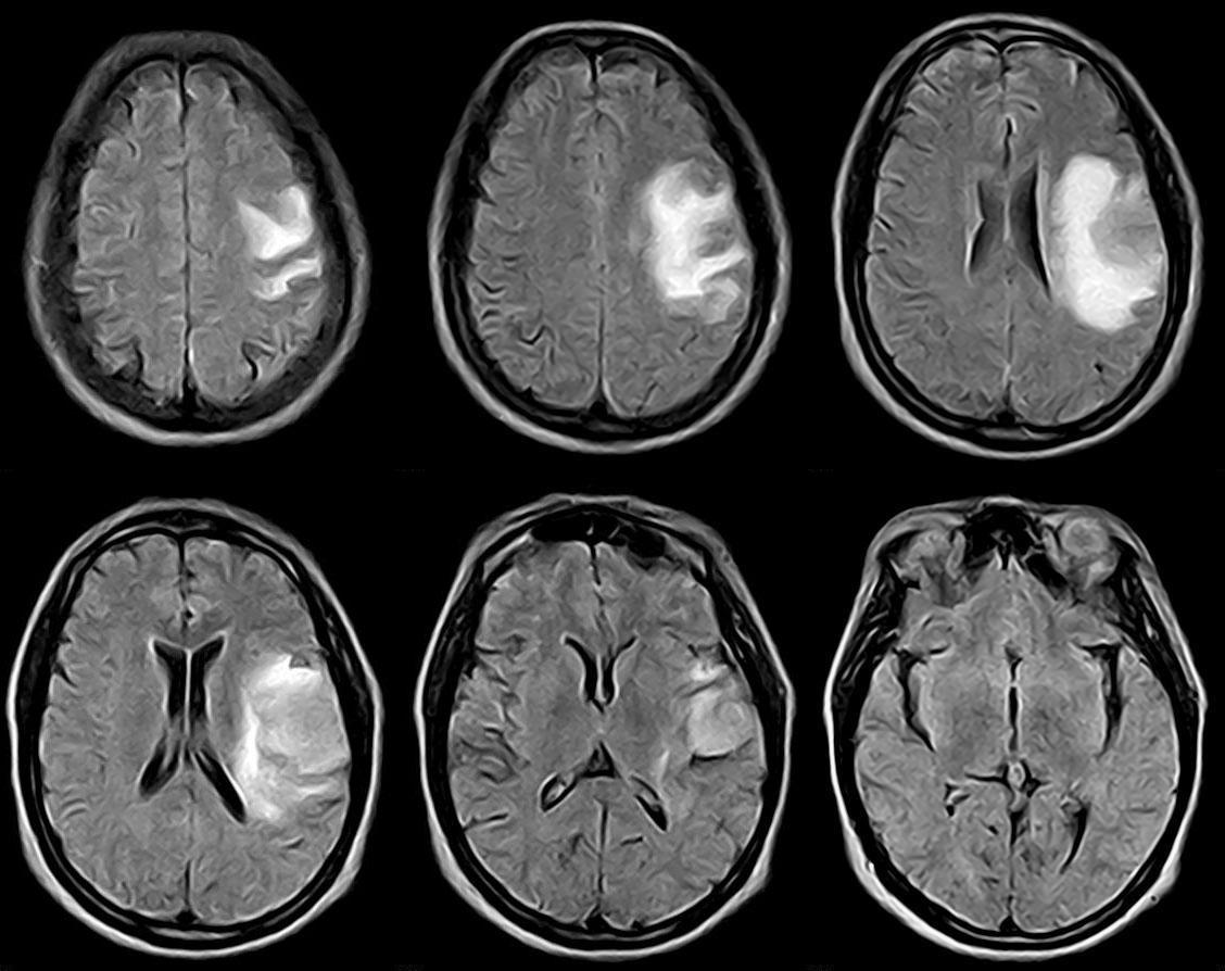额叶肿瘤有什么特征,少突胶质细胞瘤多发于额叶