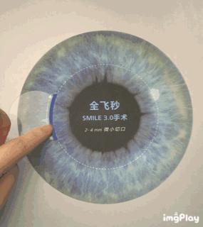 激光治疗近视眼手术十大危害,近视眼激光手术有什么风险和危害