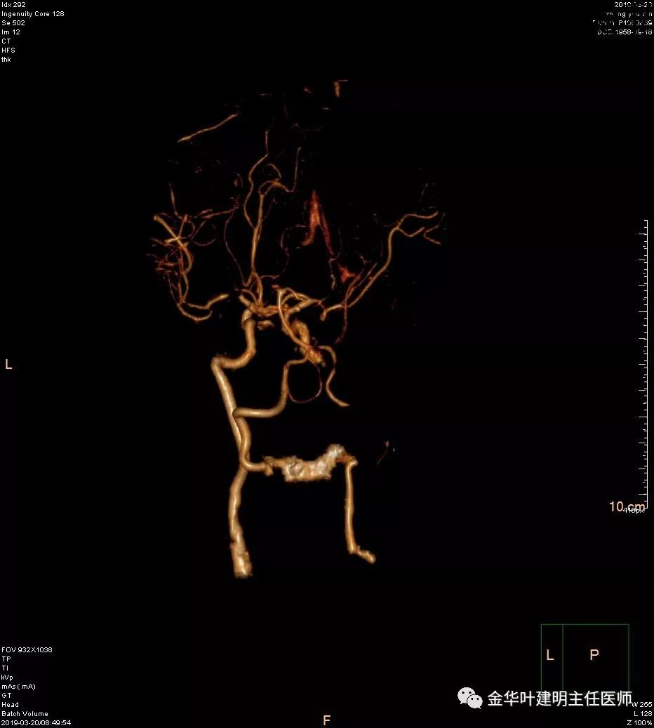 左肺下叶恶性病变,左肺上叶和下叶都有血管畸形