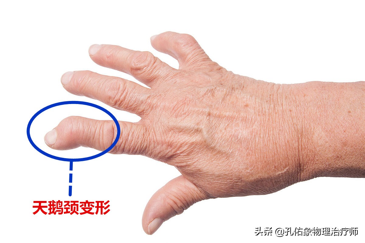 手指发胀捏不拢拳是什么原因,手指发胀不灵活咋回事