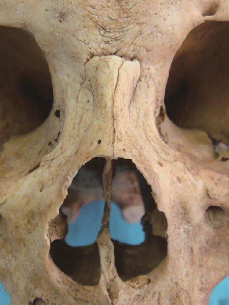 鼻头高度不够怎么办,我的鼻头老是红的怎么办