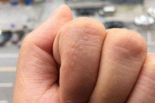 手指长脚气,手指上出现脚气