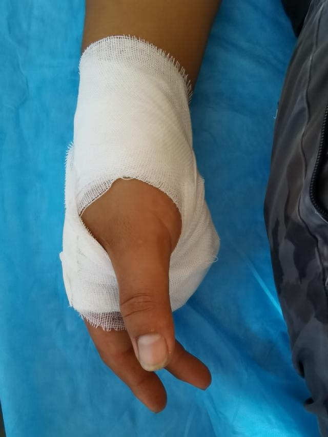 手部拳击骨折，不需要石膏固定，更不需要手术！！