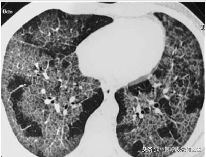 肺泡蛋白沉积症是严重的病吗,长期干咳一定是肺泡蛋白沉积症