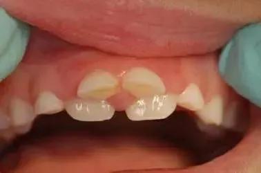 乳牙还没掉需要矫正吗,乳牙没掉完全