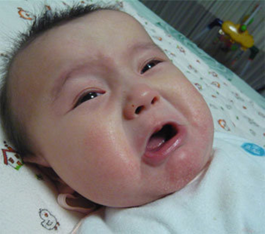 宝宝对牛奶蛋白过敏起湿疹怎么办,宝宝牛奶蛋白过敏湿疹反复怎么办