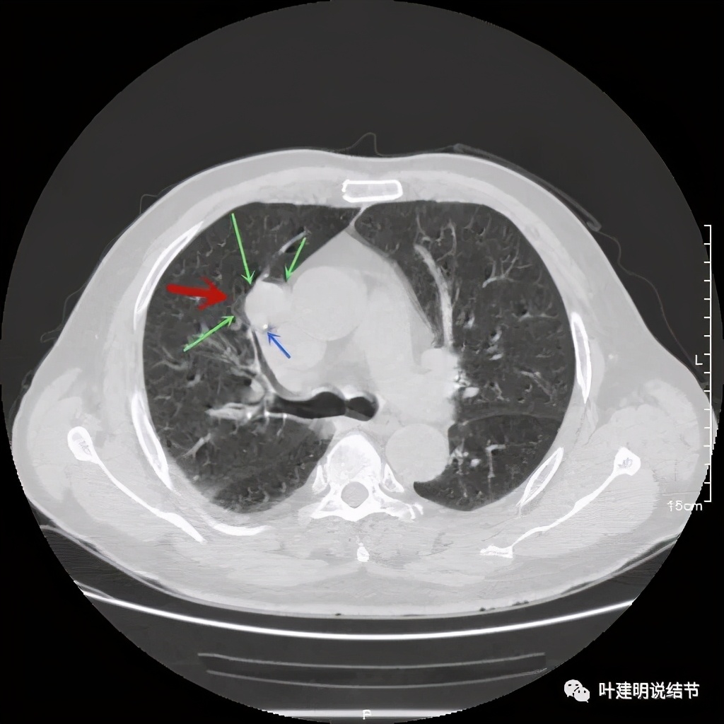 误诊报告图片,误诊案例及案例分析