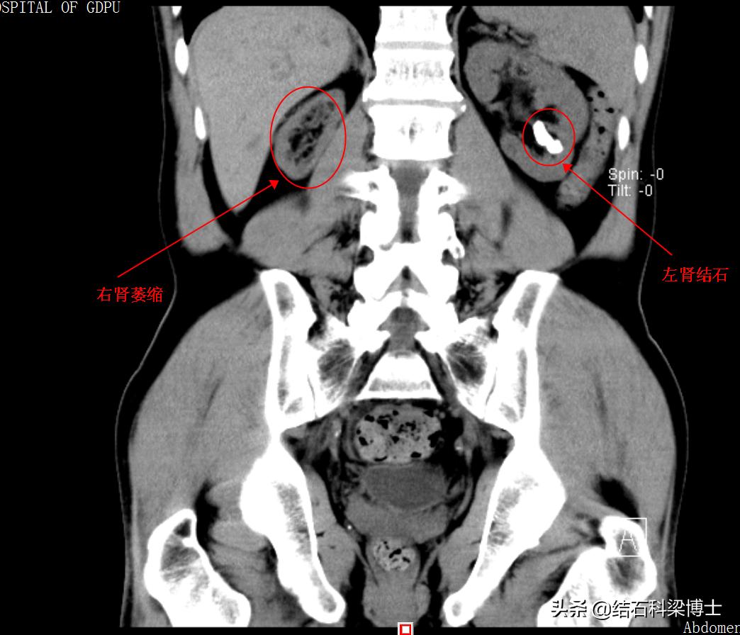体外冲击波碎石对肾造成萎缩吗,左肾结石萎缩右肾积水怎么办