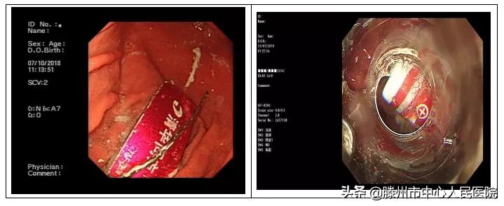 内镜下成功取出食管异物,消化内科取异物