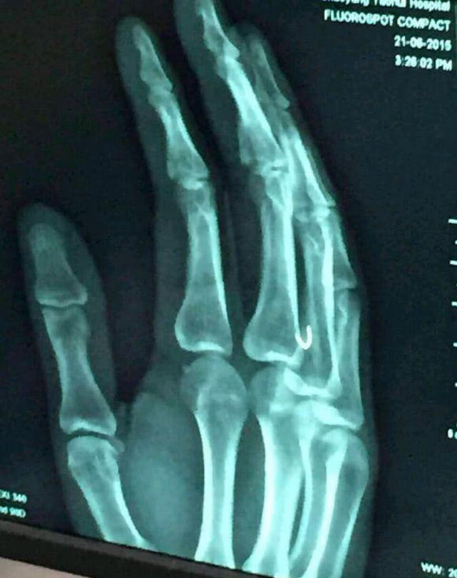 草鱼受伤怎么恢复,10斤草鱼手指受伤