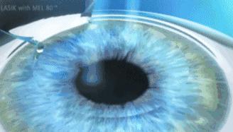 近视眼手术后的亲身经历2020,近视眼手术10年后的亲身经历