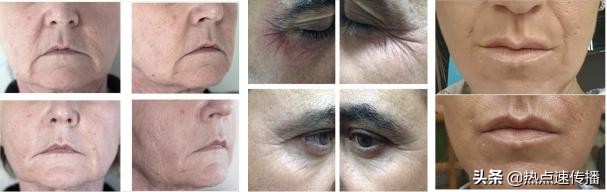 MESOSHINE艾丽思法国医疗级黑科技医美品牌将登入中国