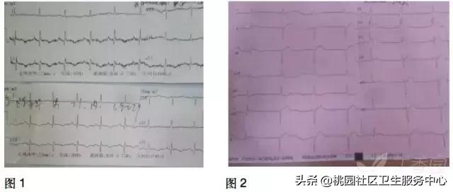 早期心梗心电图能查出来吗,警惕这种要命的心电图表现