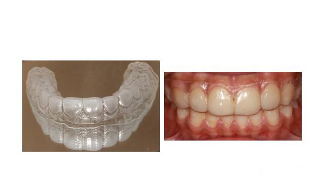 牙齿矫正完后不戴保持器会怎么样,牙齿矫正后不戴保持器会怎么样