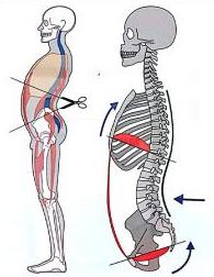 怎么能快速治疗肋骨外翻,如何矫正肋骨外翻