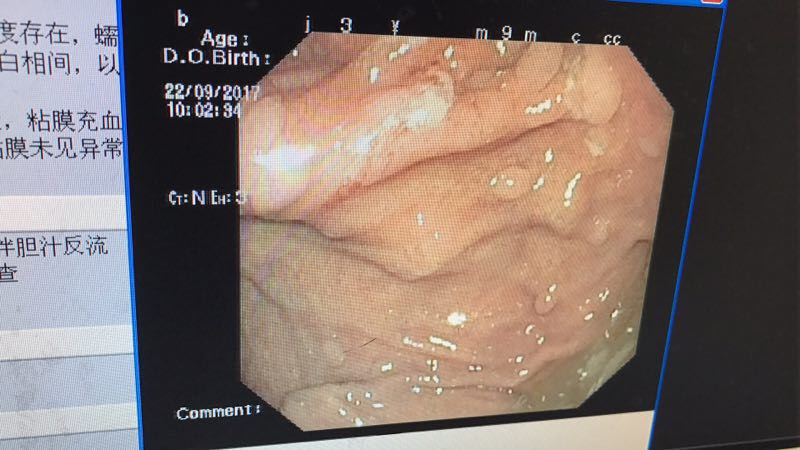 你的胃病是怎么挺过来的,肠胃炎的表现症状有哪些怎么缓解