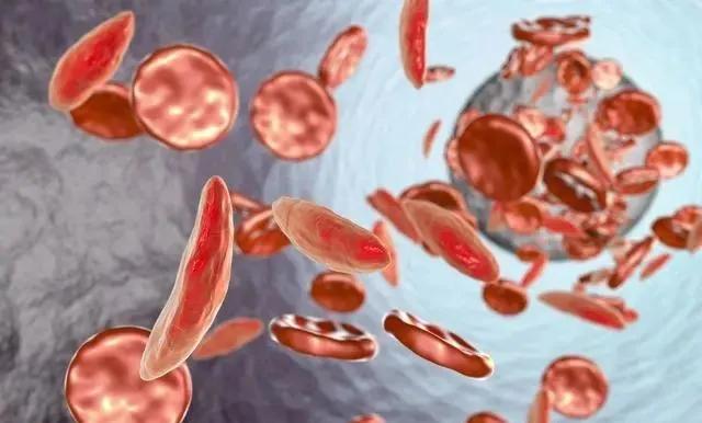 肛瘘漏粪和流血哪个更严重,肛瘘是漏粪吗