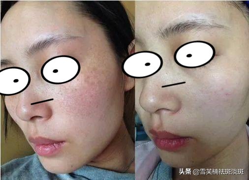 怎样祛斑安全不反弹,怎样祛斑最有效彻底不反弹的方法