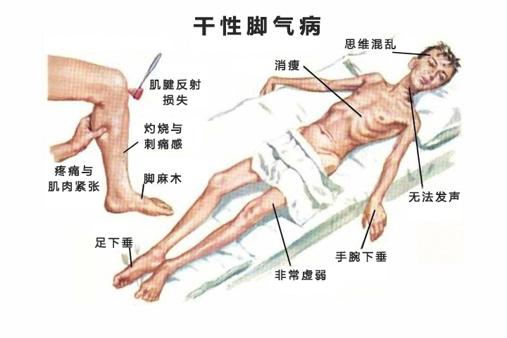 维生素b1缺乏脚气症状,维生素b1缺乏型脚气