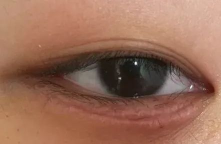 眼整形常见手术方式,眼整形美容手术