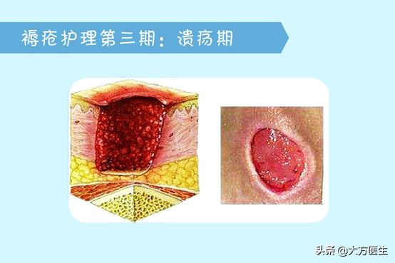 长年卧床得褥疮用什么方法好得快,病人久睡的褥疮怎么治疗