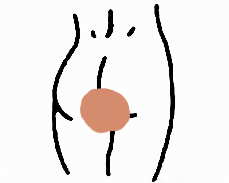 臀部里长了个硬硬的瘤子,臀部上长个瘤子不疼不痒软软的