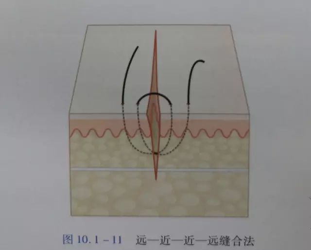 伤口闭合的正确方法,伤口清创的详细步骤