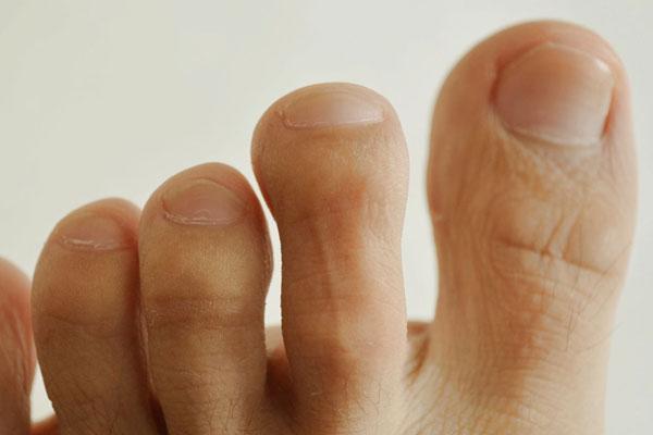 脚指甲旁边肉一碰就疼怎么办,为什么脚趾甲会长到肉里