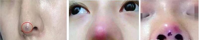 线雕隆鼻能维持几年还是那么挺,线雕隆鼻真的能吸收吗