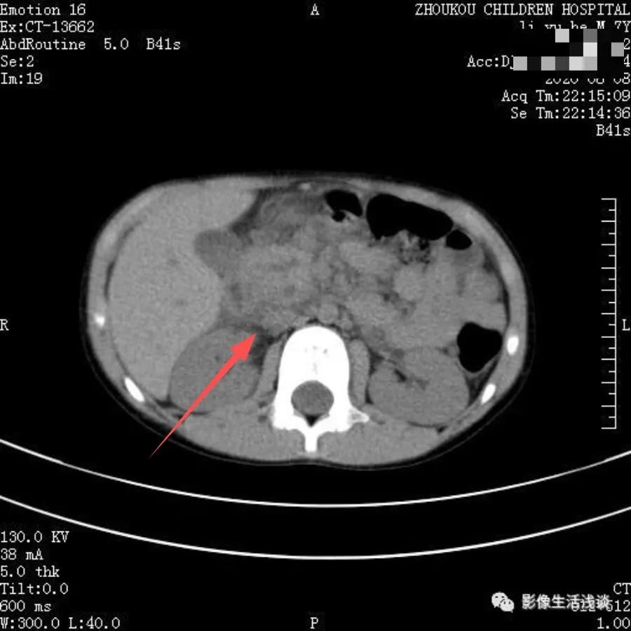 小朋友腹痛呕吐无其他症状,孩子有腹痛呕吐症状家长切莫大意