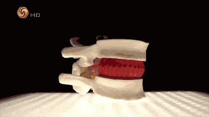 专家教你如何防治腰椎间盘突出症,腰椎间盘突出和腰突有什么关系