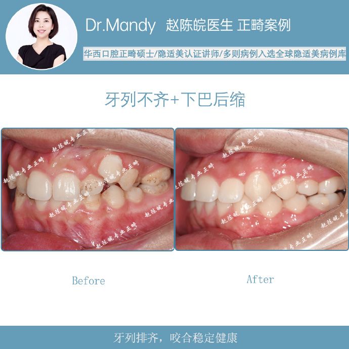 杭州牙齿隐形矫正,杭州成人隐形矫正牙齿优惠