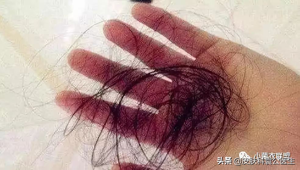 脱发严重但是头发还是很浓密,脱发头发油腻怎么办