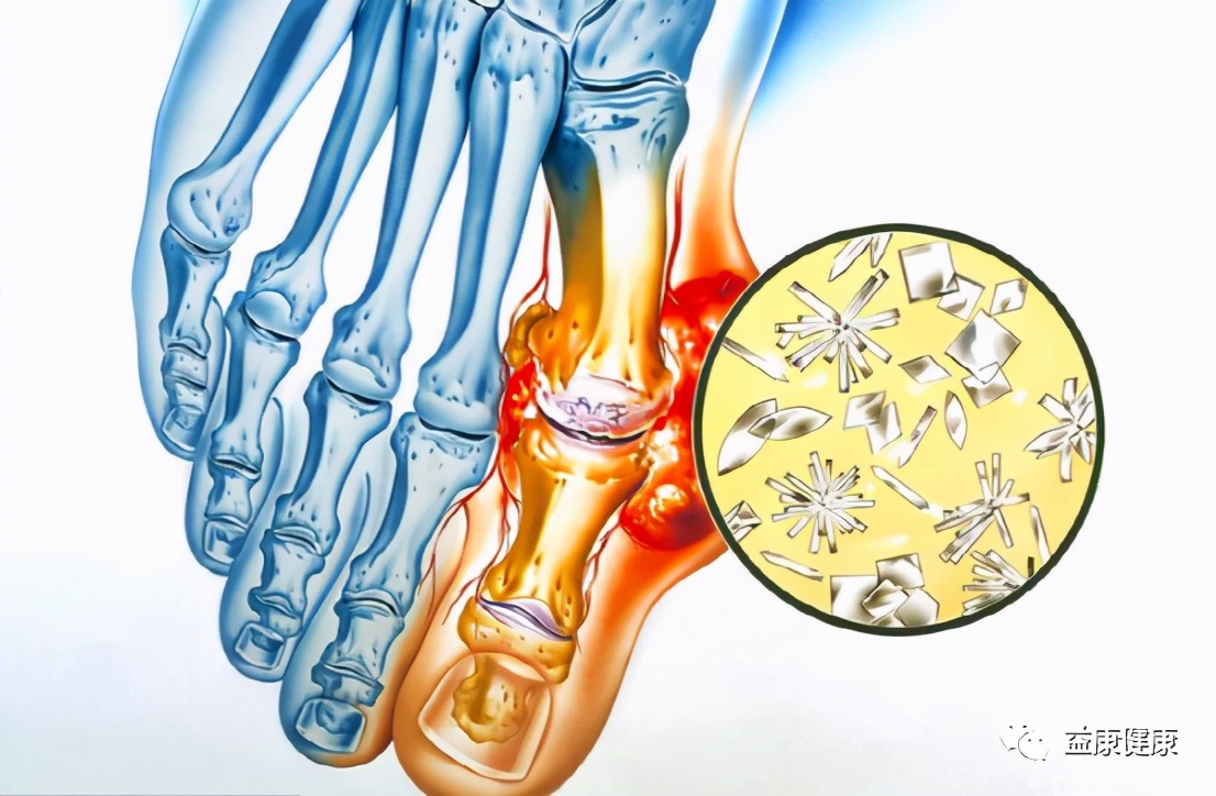 尿酸高看脚就知道,尿酸高看中医看多久