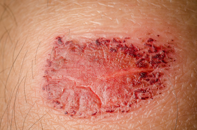 伤疤结痂怎么老不掉啊,伤疤结痂后为啥很长时间不愈合