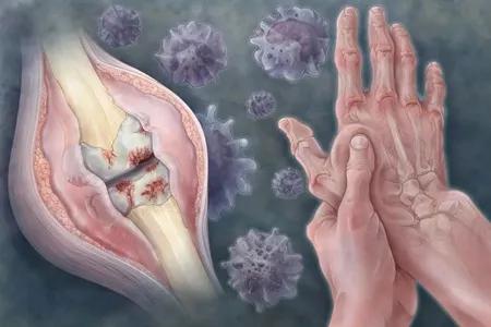 类风湿关节炎药物治疗的原则包括,类风湿关节炎治疗原则