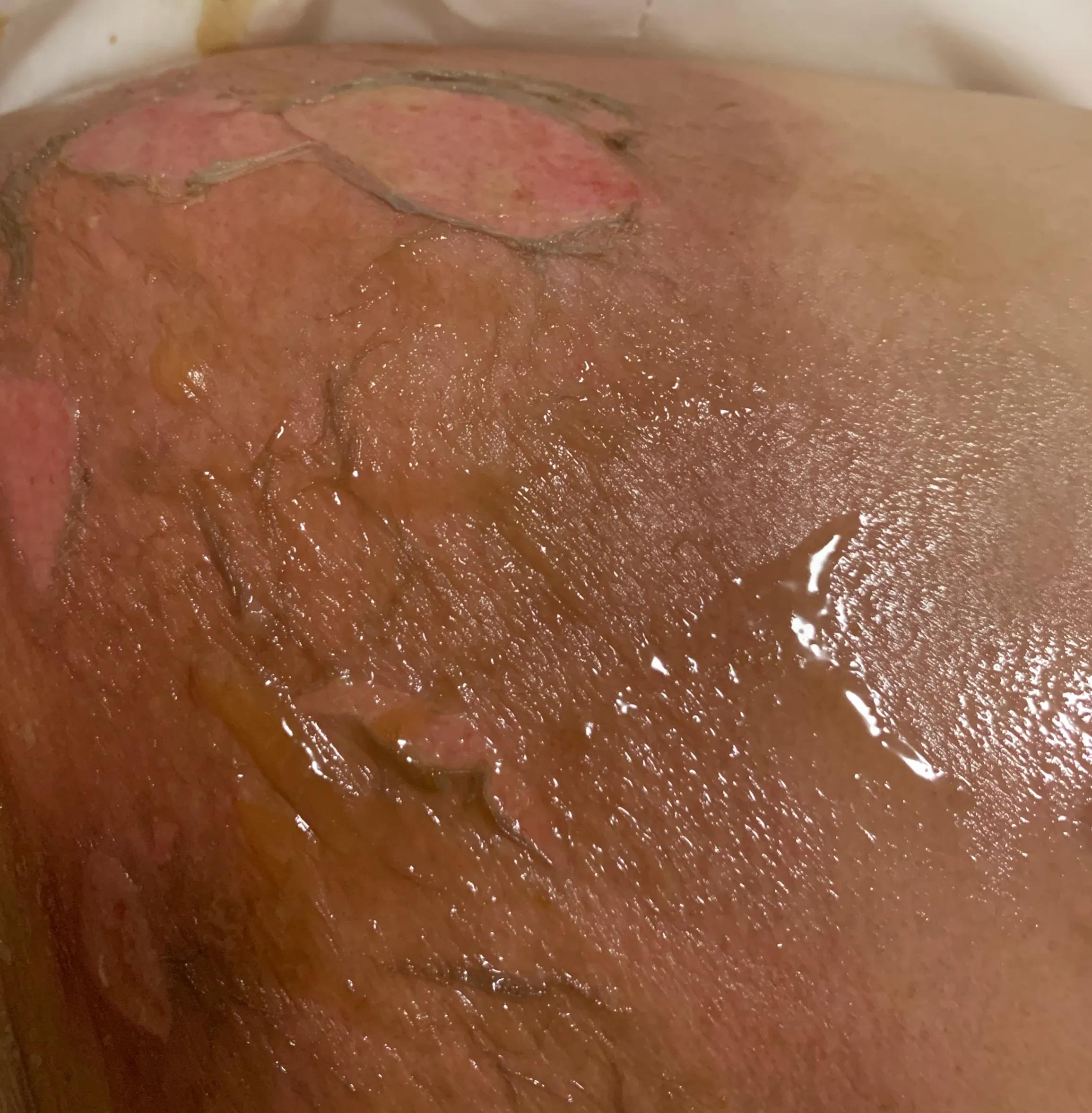 浅二度烫伤14天恢复图片,宝宝浅二度烫伤多久能恢复正常