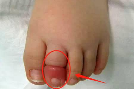 两岁宝宝腿上被虫子咬了肿很大,孩子脚被虫子咬了整个脚肿了图片