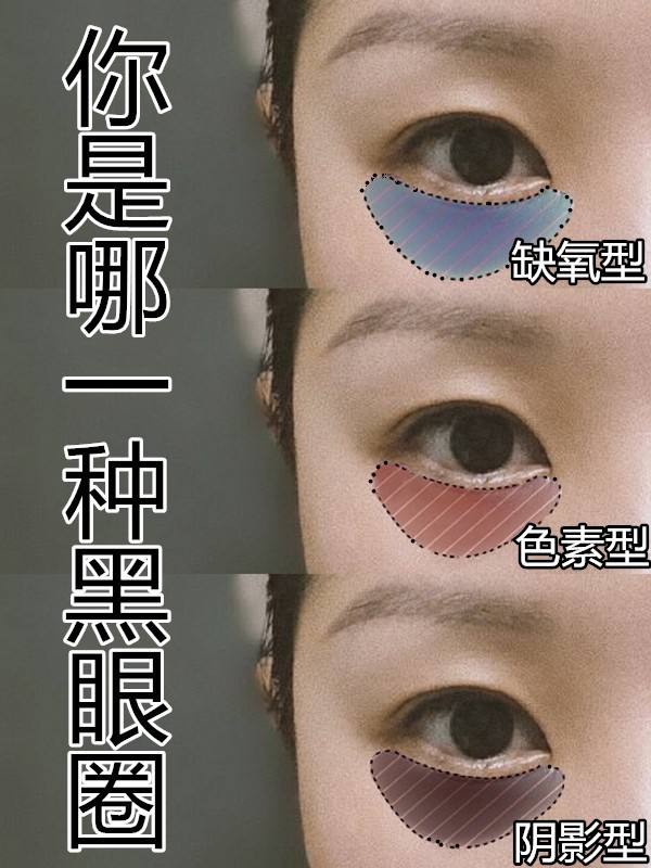 常年黑眼圈护肤品没效果,护肤品去黑眼圈用哪种