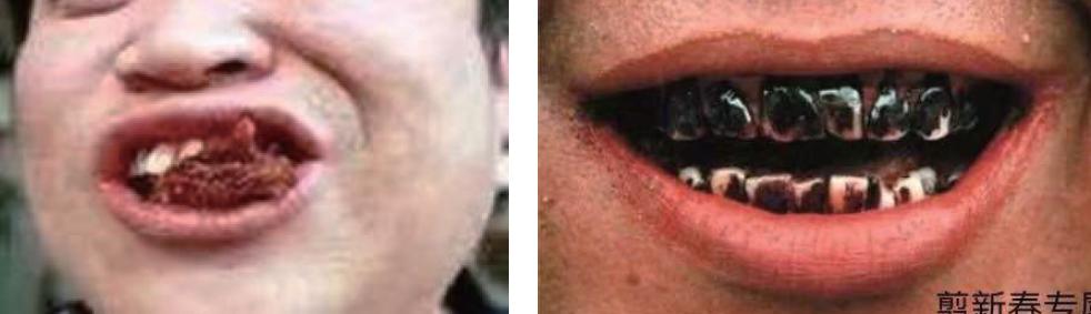 吃槟榔口腔纤维化会自愈吗,吃槟榔口腔烂了怎么好得快