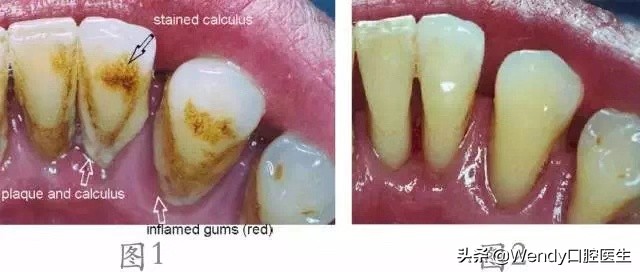 洗牙花了一千大洋,洗牙花了一千