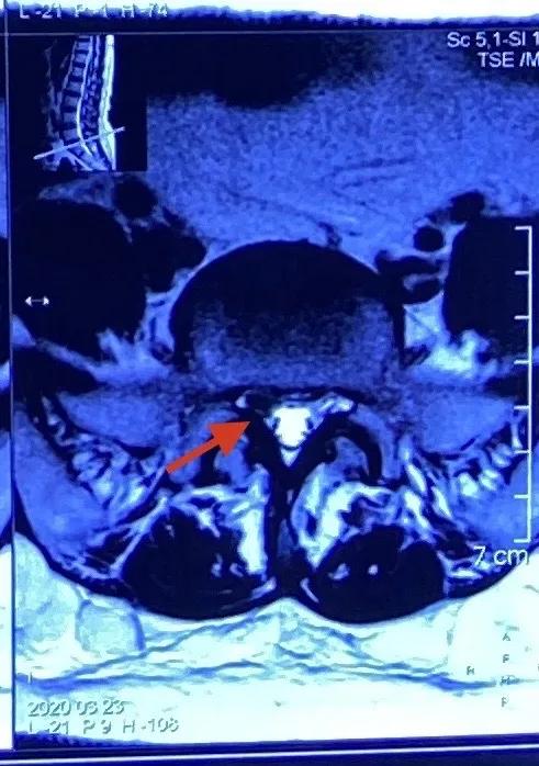 渭南治腰间盘突出哪家最好,脊柱神经外科手术