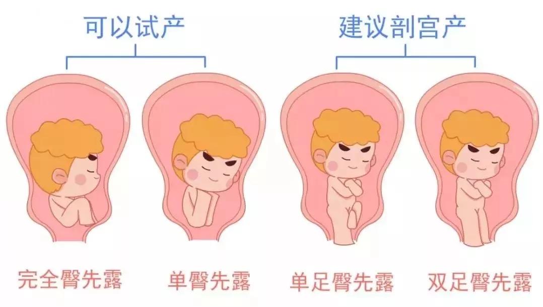 胎位中最常见的异常胎位,胎位朝上如何纠正胎位